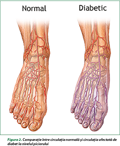 cum să tratezi entorsa articulară a picioarelor dureri articulare antibiotice