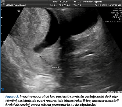 Figura 5. Imagine ecografică la o pacientă cu vârsta gestaţională de 9 săptămâni, cu istoric de avort recurent de trimestrul al II-lea, anterior montării firului de cerclaj, care a născut prematur la 32 de săptămâni