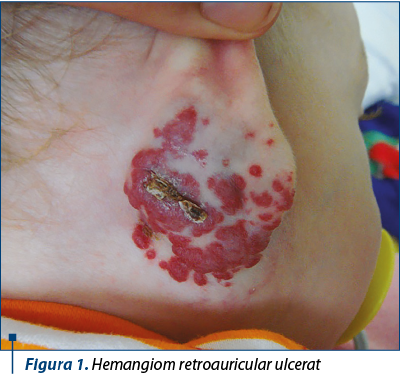 Figura 1. Hemangiom retroauricular ulcerat