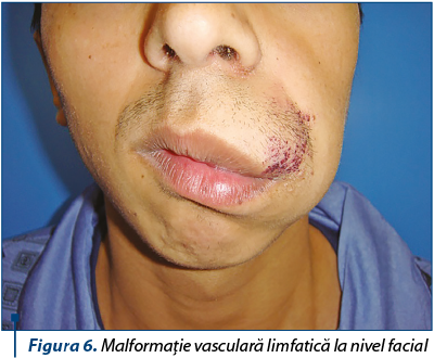 Figura 6. Malformaţie vasculară limfatică la nivel facial