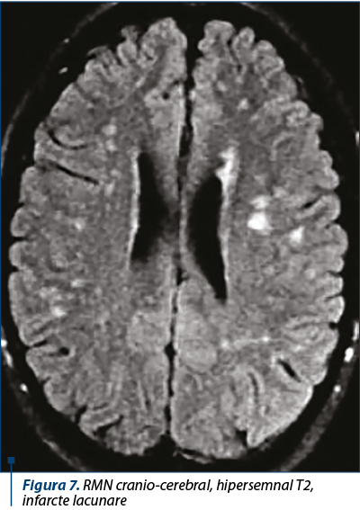Figura 7. RMN cranio-cerebral, hipersemnal T2, infarcte lacunare