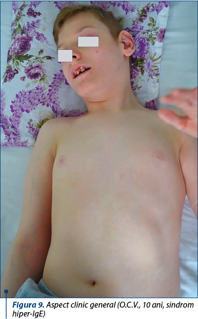 Figura 9. Aspect clinic general (O.C.V., 10 ani, sindrom hiper-IgE)