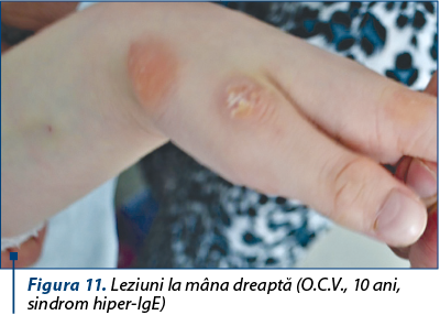 Figura 11. Leziuni la mâna dreaptă (O.C.V., 10 ani, sindrom hiper-IgE)