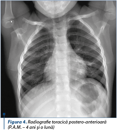 Figura 4. Radiografie toracică postero-anterioară (P.A.M. – 4 ani şi o lună)