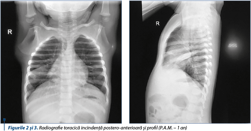 Figurile 2 şi 3. Radiografie toracică incindenţă postero-anterioară şi profil (P.A.M. – 1 an)