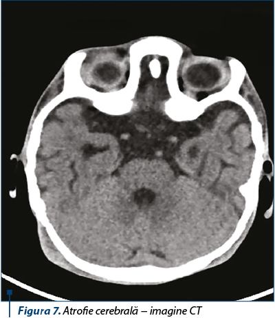 Figura 7. Atrofie cerebrală − imagine CT