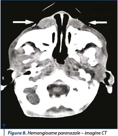 Figura 8. Hemangioame paranazale – imagine CT