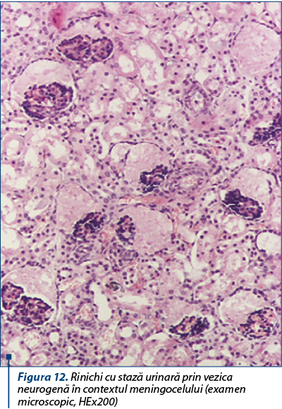 Figura 12. Rinichi cu stază urinară prin vezica neurogenă în contextul meningocelului (examen micros