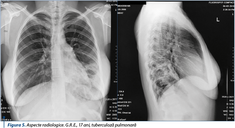 Figura 5. Aspecte radiologice. G.R.E., 17 ani, tuberculoză pulmonară