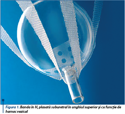 Figura 1. Banda în H, plasată suburetral în unghiul superior şi cu funcţie de hamac vezical