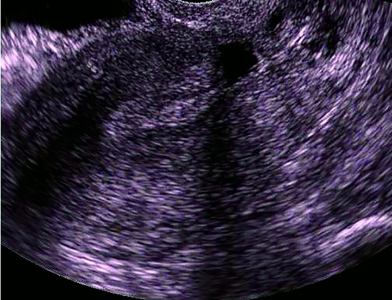 Figura 1. Istmocel (ecografie transvaginală, uter în secţiune longitudinală; colecţie personală)