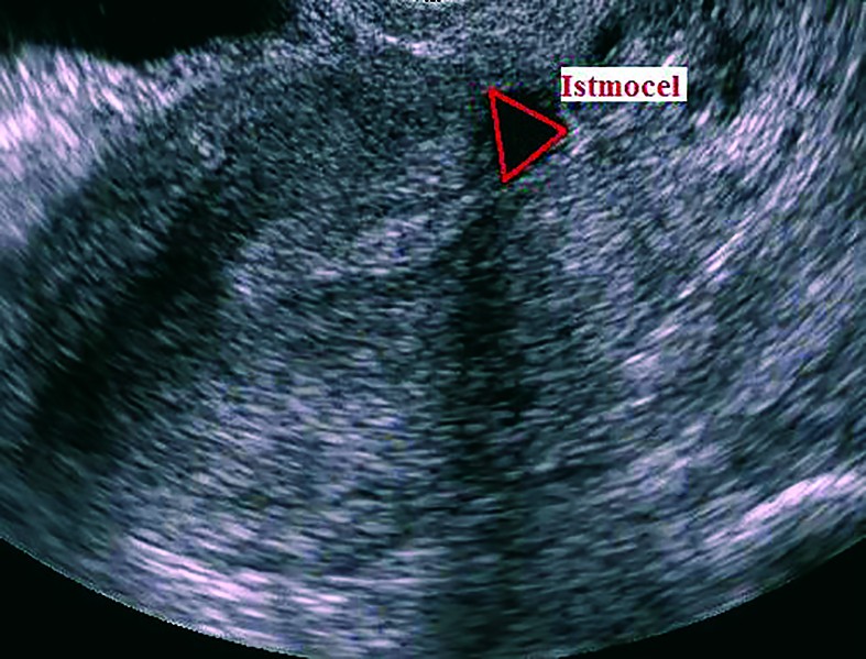 Figura 2. Istmocel (ecografie transvaginală, uter în secţiune longitudinală; colecţie personală)