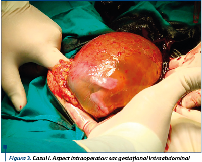 Figura 3. Cazul I. Aspect intraoperator: sac gestaţional intraabdominal