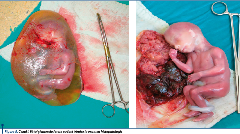 Figura 5. Cazul I. Fătul şi anexele fetale au fost trimise la examen histopatologic