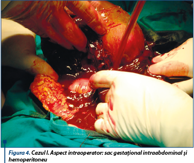 Figura 4. Cazul I. Aspect intraoperator: sac gestaţional intraabdominal şi hemoperitoneu