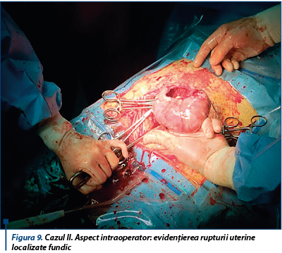 Figura 9. Cazul II. Aspect intraoperator: evidenţierea rupturii uterine localizate fundic