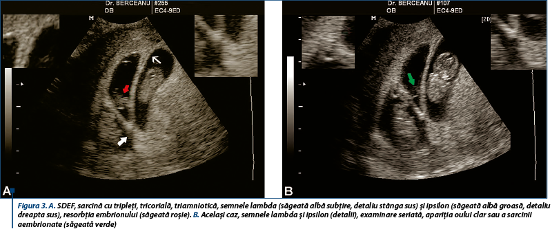 gold damage label Sindromul de dispariţie embrio-fetală în gestaţia multiplă