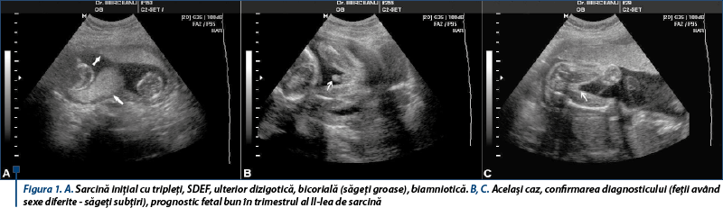 Figura 1. A. Sarcină iniţial cu tripleţi, SDEF, ulterior dizigotică, bicorială (săgeţi groase), biamniotică. B, C. Acelaşi caz, confirmarea diagnosticului (feţii având sexe diferite - săgeţi subţiri), prognostic fetal bun în trimestrul al II-lea de sarcină