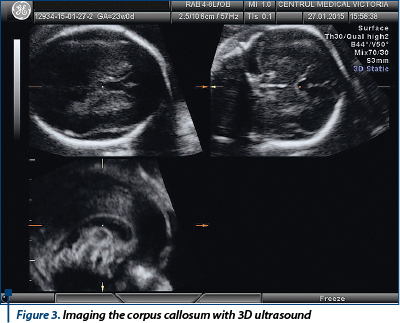 Figure 3. Imaging the corpus callosum with 3D ultrasound