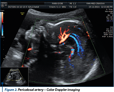 Figure 2. Pericalosal artery – Color Doppler imaging 