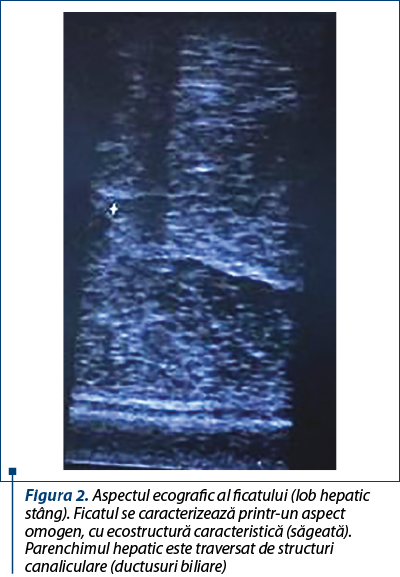 Figura 2. Aspectul ecografic al ficatului (lob hepatic stâng). Ficatul se caracterizează printr-un aspect omogen, cu eco­structură caracteristică (săgeată). Parenchimul he­pa­tic este traversat de structuri canaliculare (ductusuri bili­are)