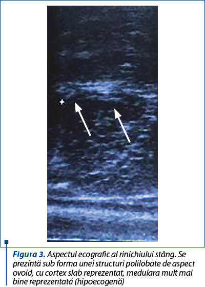 Figura 3. Aspectul ecografic al rinichiului stâng. Se prezintă sub forma unei structuri polilobate de aspect ovoid, cu cortex slab reprezentat, medulara mult mai bine reprezentată (hipoecogenă)