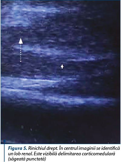 Figura 5. Rinichiul drept. În centrul imaginii se identifică un lob renal. Este vizibilă delimitarea corticomedulară (săgeată punctată)