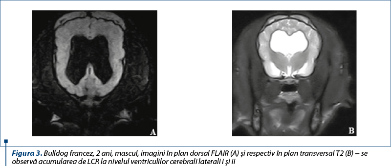 Figura 3. Bulldog francez, 2 ani, mascul, imagini în plan dorsal FLAIR (A) şi respectiv în plan transversal T2 (B) − se observă acumularea de LCR la nivelul ventriculilor cerebrali laterali I şi II
