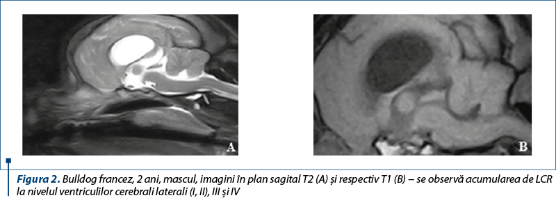 Figura 2. Bulldog francez, 2 ani, mascul, imagini în plan sagital T2 (A) şi respectiv T1 (B) − se observă acumularea de LCR la nivelul ventriculilor cerebrali laterali (I, II), III şi IV