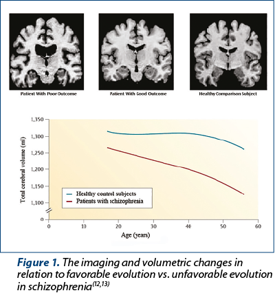 Figure 1. The imaging and volumetric changes in relation to favorable evolution vs. unfavorable evolution in schizophrenia(12,13)