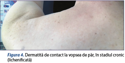 Figura 4. Dermatită de contact la vopsea de păr, în stadiul cronic  (lichenificată)