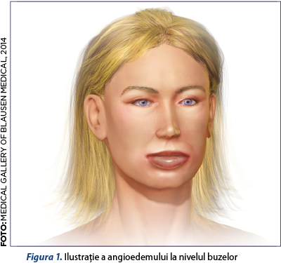 Figura 1. Ilustraţie a angioedemului la nivelul buzelor