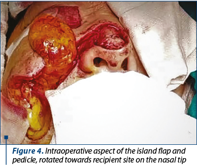 Figure 4. Intraoperative aspect of the island flap and pedicle, rotated towards recipient site on the nasal tip