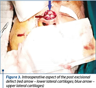 Figure 3. Intraoperative aspect of the post excisional defect (red arrow – lower lateral cartilages; blue arrow – upper lateral cartilages)