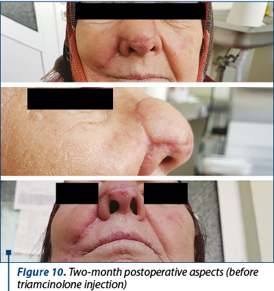 Figure 10. Two-month postoperative aspects (before triamcinolone injection)