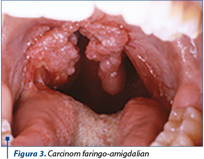 Figura 3. Carcinom faringo-amigdalian