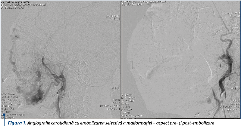 Figura 1. Angiografie carotidiană cu embolizarea selectivă a malformaţiei – aspect pre- şi post-embolizare