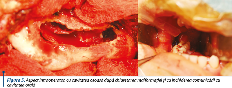 Figura 5. Aspect intraoperator, cu cavitatea osoasă după chiuretarea malformaţiei şi cu închiderea comunicării cu cavitatea orală