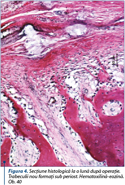 Figura 4. Secţiune histologică la o lună după operaţie. Trabeculii nou formaţi sub periost. Hematoxilină-eozină. Ob. 40