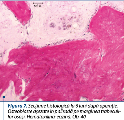 Figura 7. Secţiune histologică la 6 luni după operaţie. Osteoblaste aşezate în palisadă pe marginea tra­be­cu­li­lor osoşi. Hematoxilină-eozină. Ob. 40