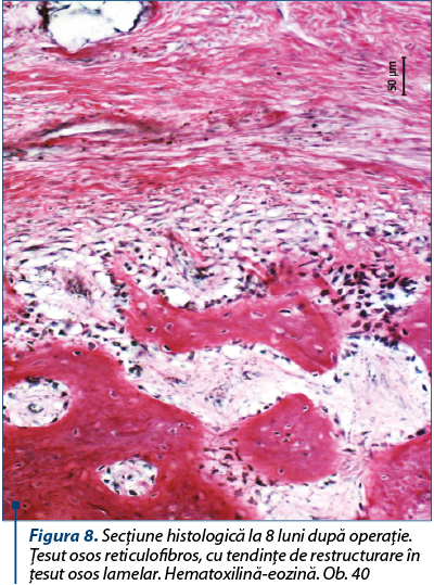 Figura 8. Secţiune histologică la 8 luni după operaţie. Ţesut osos reticulofibros, cu tendinţe de restructurare în ţesut osos lamelar. Hematoxilină-eozină. Ob. 40