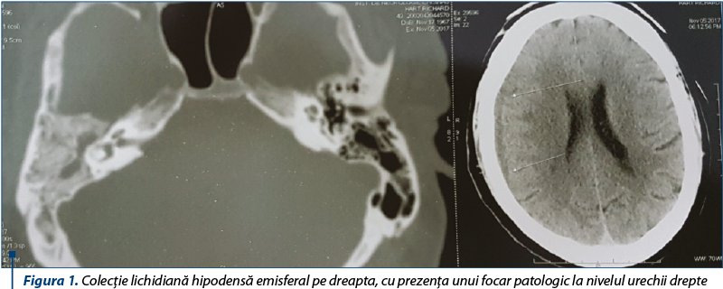 Figura 1. Colecţie lichidiană hipodensă emisferal pe dreapta, cu prezenţa unui focar patologic la nivelul urechii drepte