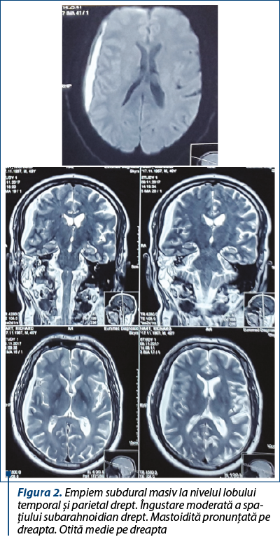 Figura 2. Empiem subdural masiv la nivelul lobului tem­po­ral şi parietal drept. Îngustare moderată a spa­ţiu­lui subarahnoidian drept. Mastoidită pronunţată pe dreapta. Otită medie pe dreapta