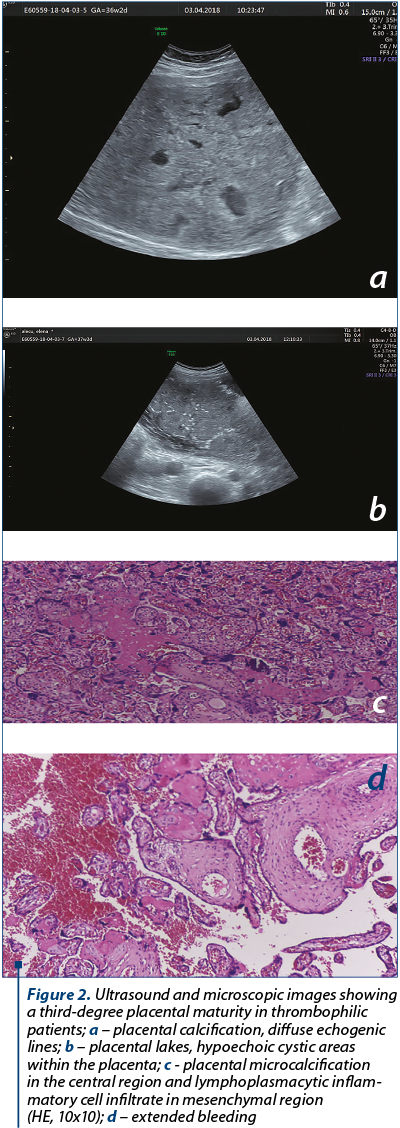 Figure 2. Ultrasound and microscopic images showing a third-degree placental maturity in thrombophilic patients; a – placental calcification, diffuse echogenic lines; b – placental lakes, hypo­echoic cystic areas within the placenta; c - placental micro­calcification in the central region and lympho­plasmacytic inflam­matory cell infiltrate in mesenchymal region  (HE, 10x10); d – extended bleeding