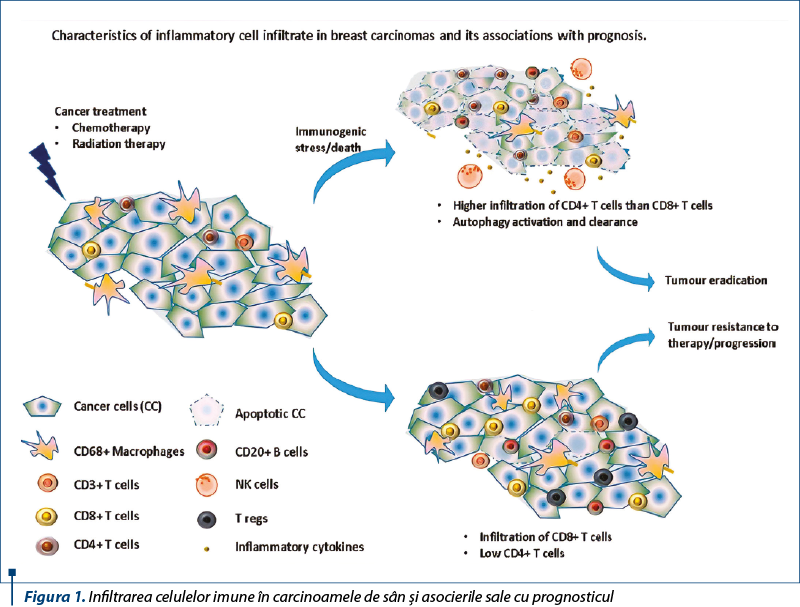 Figura 1. Infiltrarea celulelor imune în carcinoamele de sân şi asocierile sale cu prognosticul