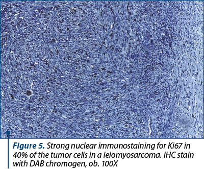 Figure 5. Strong nuclear immunostaining for Ki67 in 40% of the tumor cells in a leiomyosarcoma. IHC stain with DAB chromogen, ob. 100X
