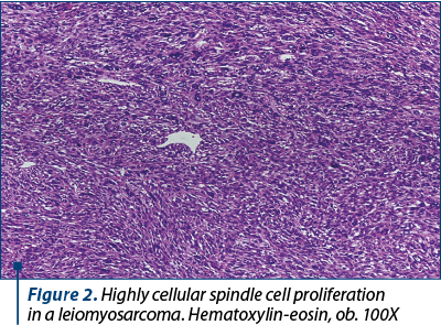 Figure 2. Highly cellular spindle cell proliferation  in a leiomyosarcoma. Hematoxylin-eosin, ob. 100X