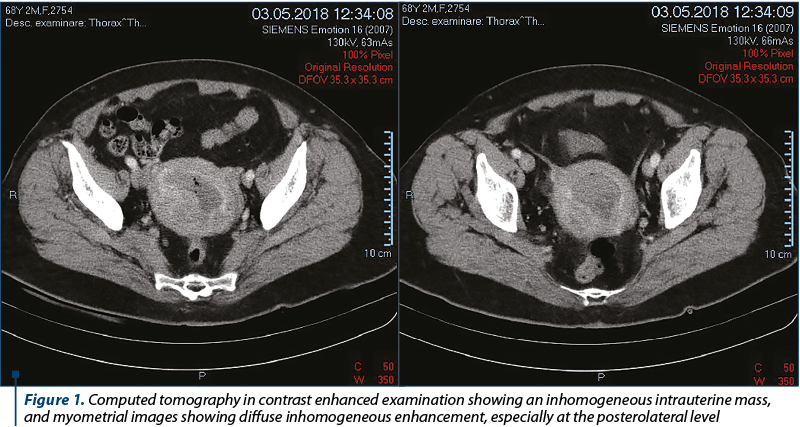 Figure 1. Computed tomography in contrast enhanced examination showing an inhomogeneous intrauterine mass, and myometrial images showing diffuse inhomogeneous enhancement, especially at the posterolateral level