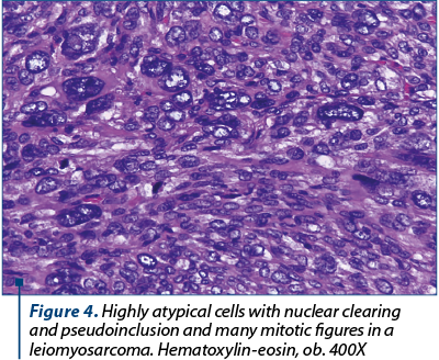Figure 4. Highly atypical cells with nuclear clearing and pseudoinclusion and many mitotic figures in a leiomyosarcoma. Hematoxylin-eosin, ob. 400X