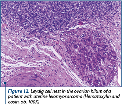 Figure 12. Leydig cell nest in the ovarian hilum of a patient with uterine leiomyosarcoma (Hematoxylin and eosin, ob. 100X)
